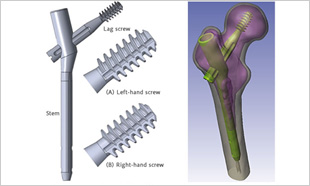 インプラントと左大腿骨近位部骨折のモデル