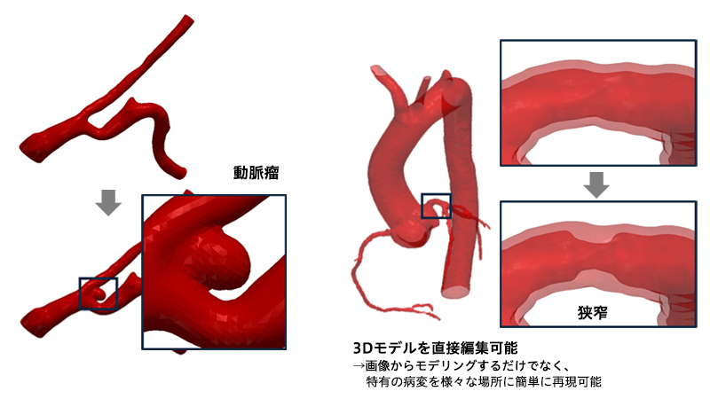 図4. 3Dモデル編集機能による病変再現