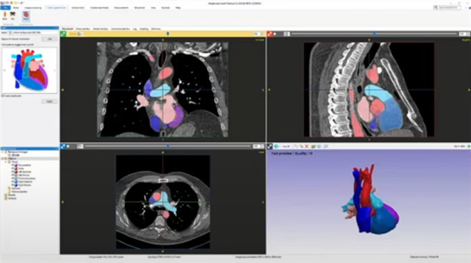 胸部CT画像からの心臓のモデル化